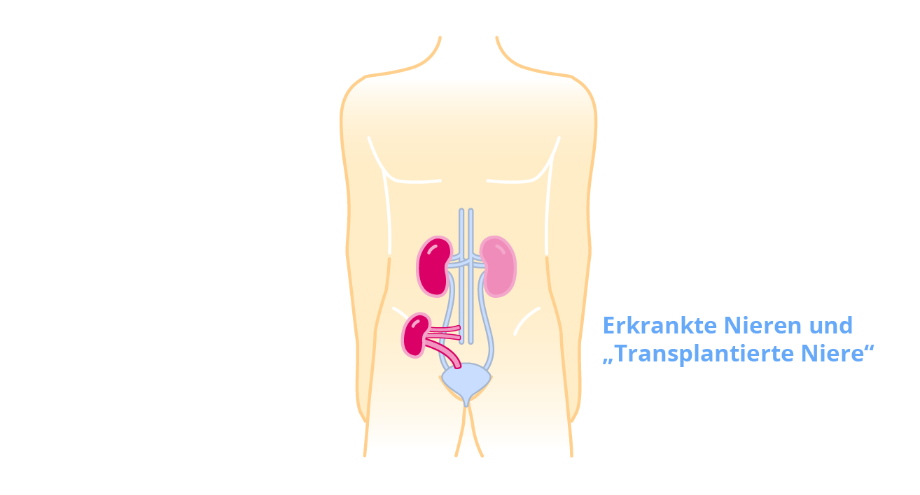 Erkrankte und transplantierte Niere