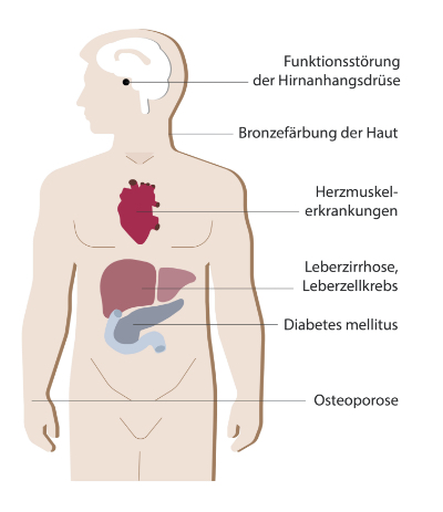 symptome-haemochromatose