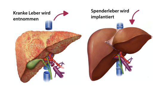 Transplantation Lebereinsatz